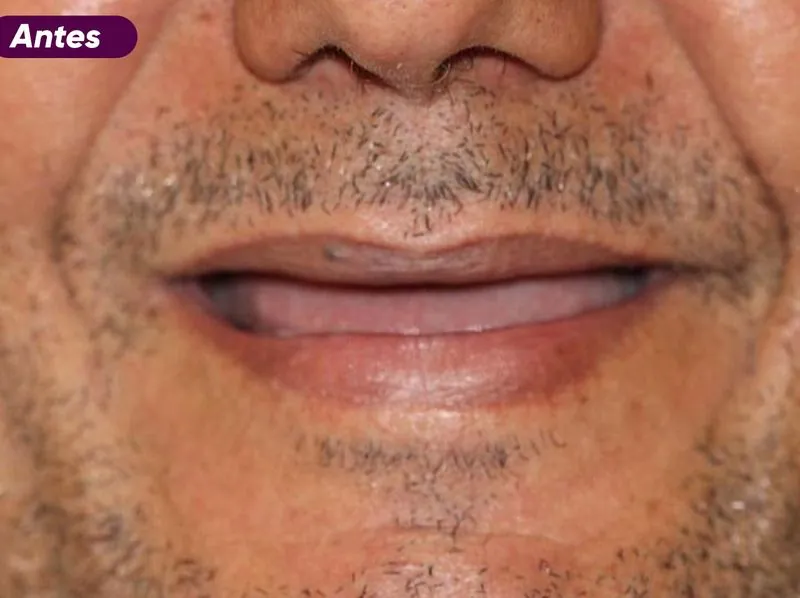 Sorriso antes do tratamento de implante dentário