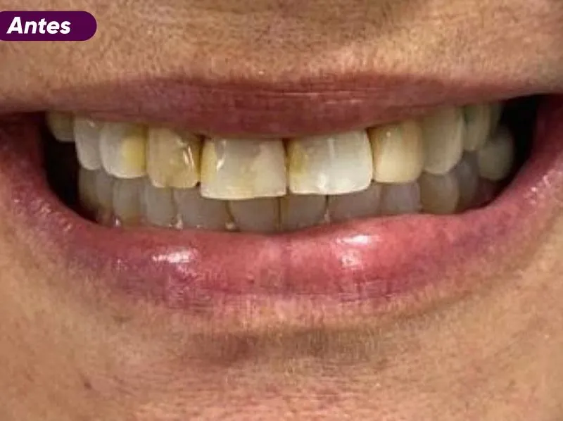 Sorriso antes do tratamento de implante dentário