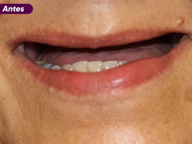 Sorriso antes do tratamento de implante dentário