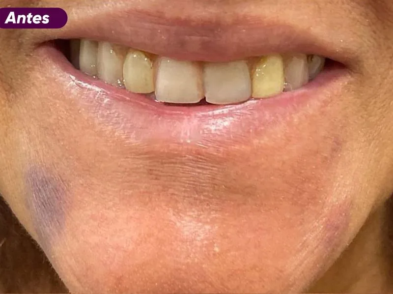 Sorriso antes do tratamento de implante dentário