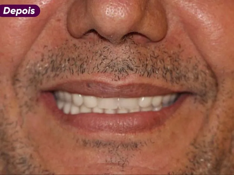 Sorriso depois do tratamento de implante dentário