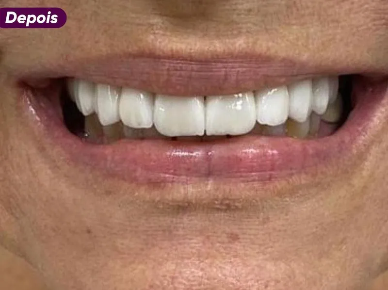 Sorriso depois do tratamento de implante dentário