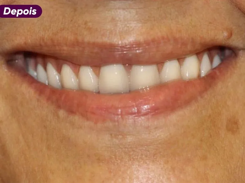 Sorriso depois do tratamento de implante dentário