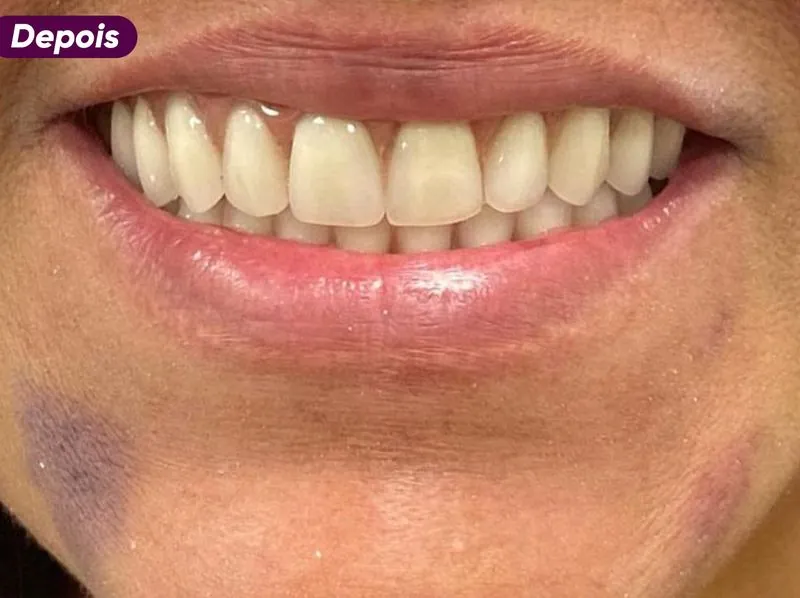 Sorriso depois do tratamento de implante dentário